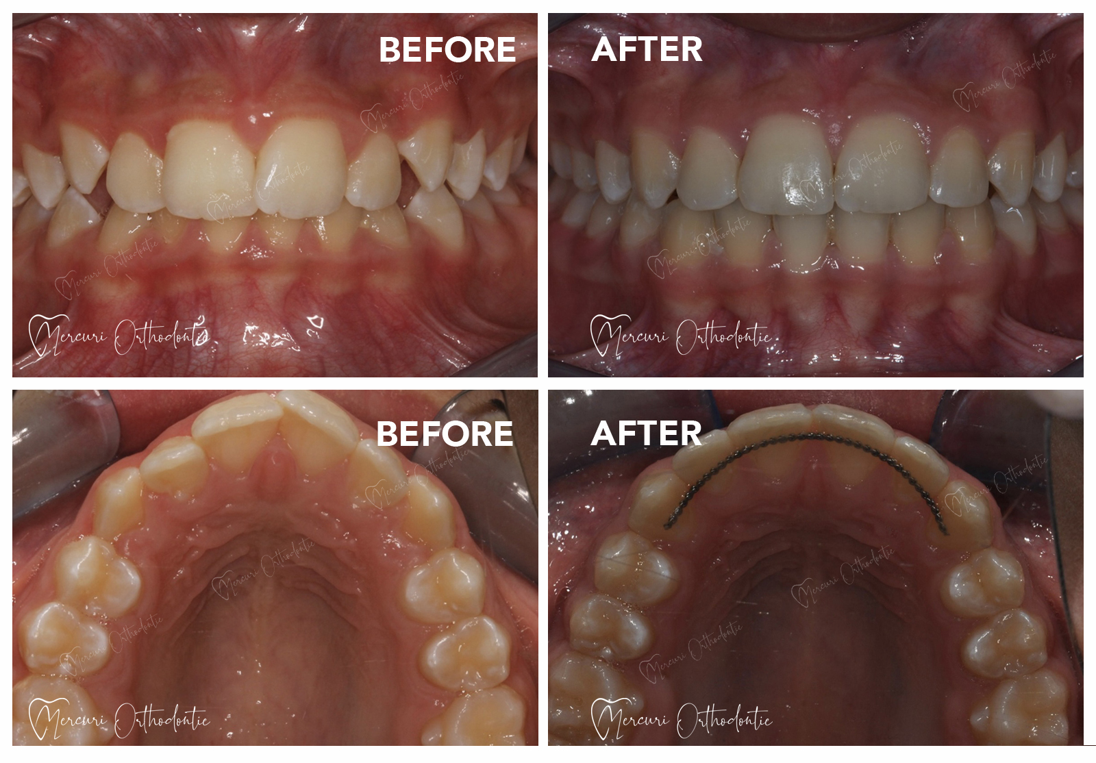 Class I malocclusion - Mercuri Orthodontie Ecublens (Lausanne)