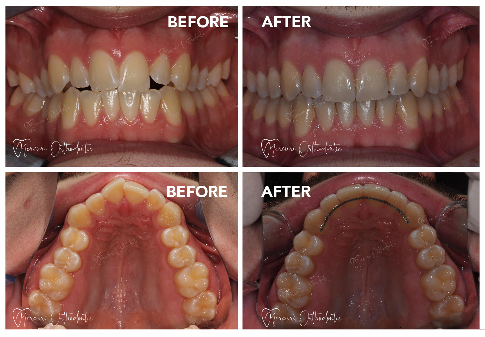 Exemple de cas cliniques en orthodontie